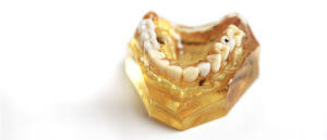 Implantate Zahn Heisingen Zahnarzt