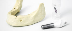 Zahnarzt Heisingen Implantate